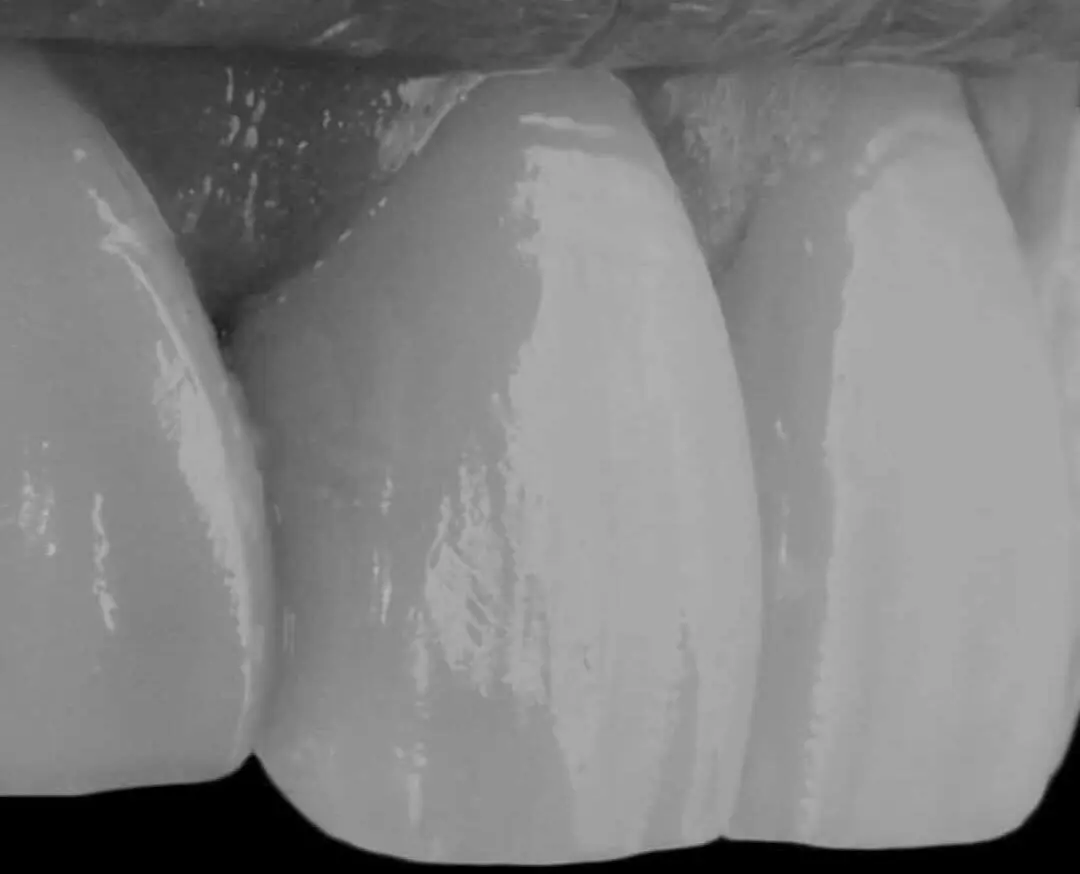 como recuperar el esmalte de los dientes - Cómo aumentar el esmalte de los dientes