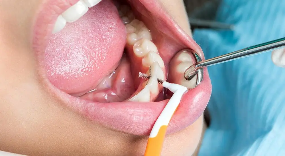 cepillo interdental ortodoncia - Cómo elegir el cepillo interdental