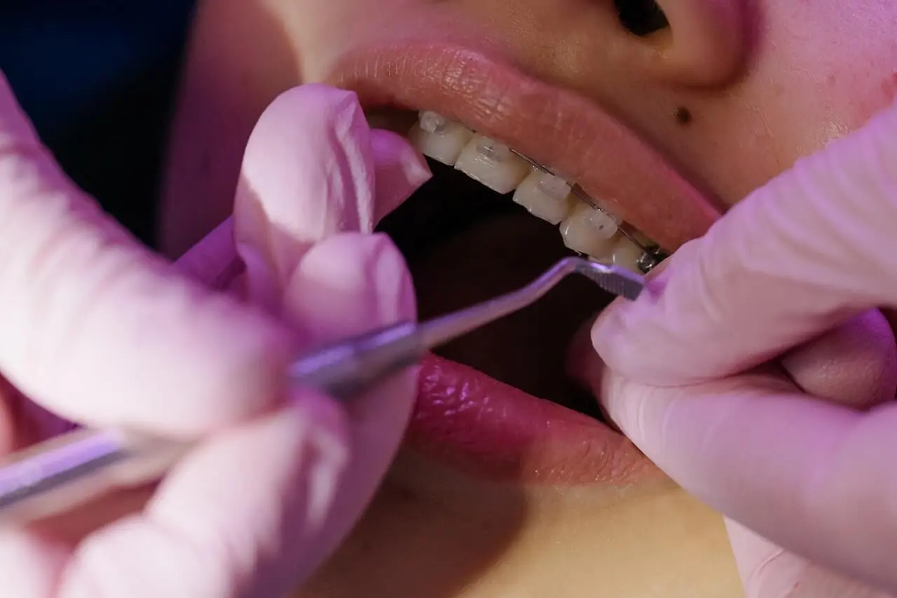 arcos ortodoncia - Cómo se diferencian los arcos de ortodoncia