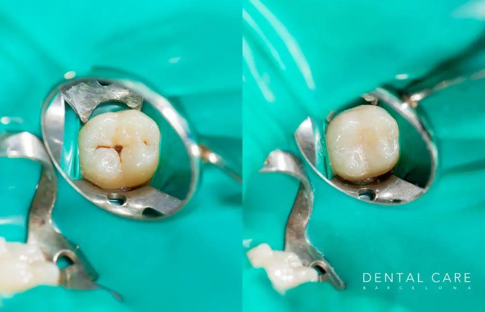 relleno de dientes - Cómo se hace un relleno en los dientes