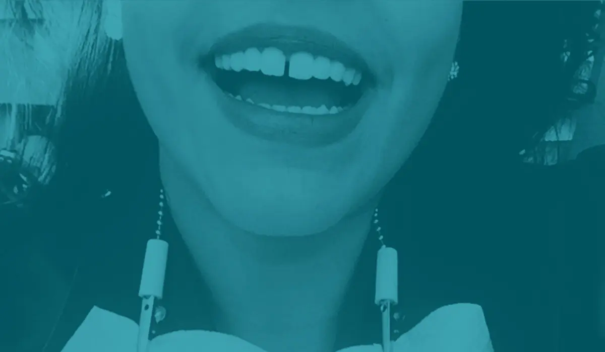 abertura entre los dientes - Cómo se llama cuando hay espacio entre los dientes