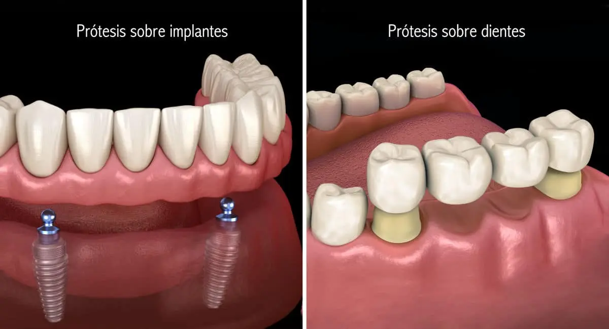 se puede agregar un diente a una protesis - Cómo se llama el diente que sostiene una prótesis