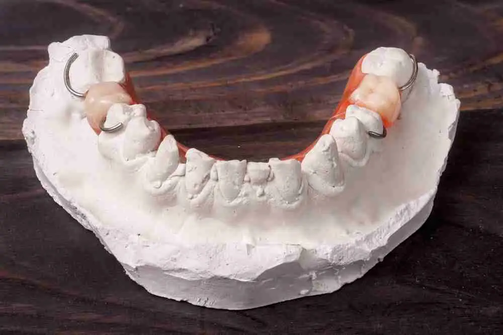 dientes impresos en 3d - Cómo se llama la impresión de los dientes