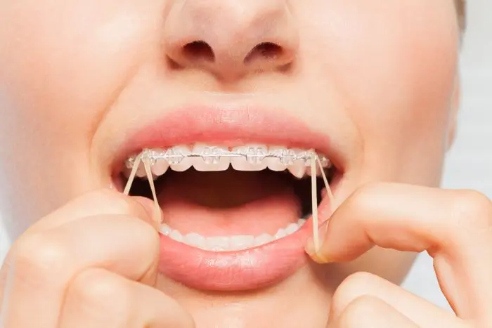 gomitas para ortodoncia - Cómo se llaman las gomitas que van en los brackets