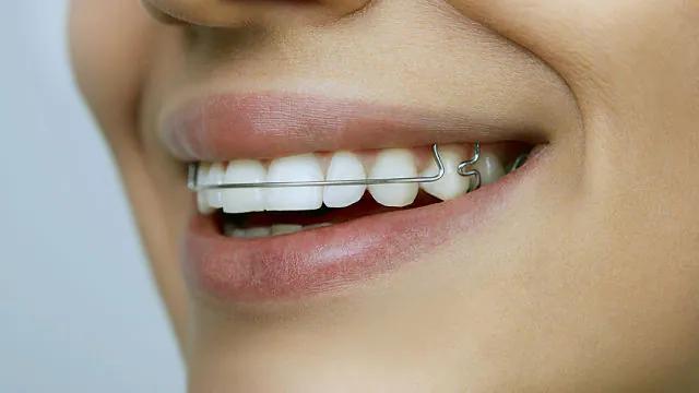 aparatos para corregir los dientes - Cómo se llaman los aparatos para corregir los dientes