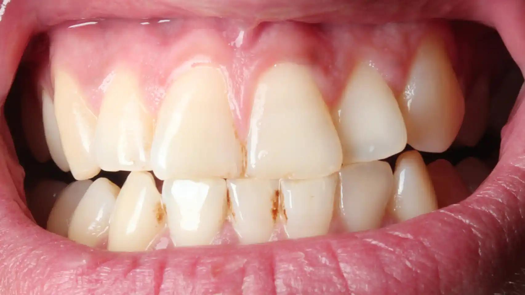 como eliminar placas de los dientes - Cómo se puede quitar la placa bacteriana