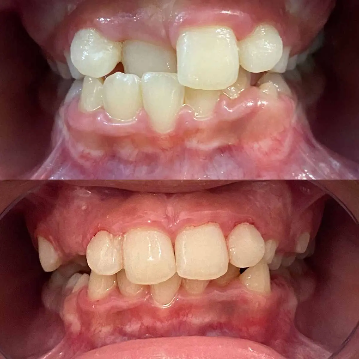 ortopedia de dientes - Cuándo usar ortopedia maxilar