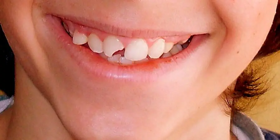 cuanto cuesta rellenar un diente roto - Cuánto cuesta el relleno de un diente