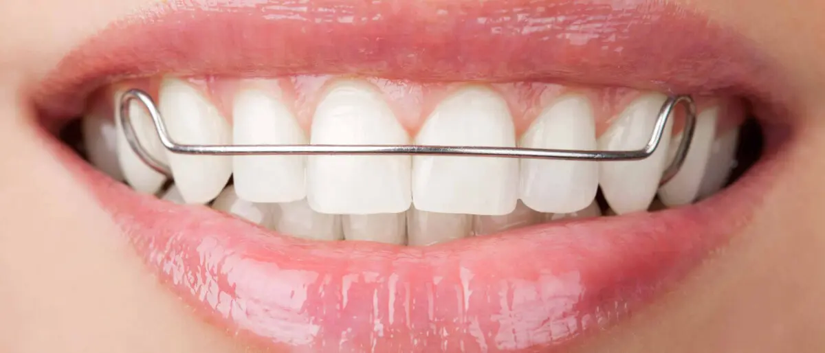 tratamiento para emparejar los dientes - Cuánto cuesta el tratamiento de alineadores dentales