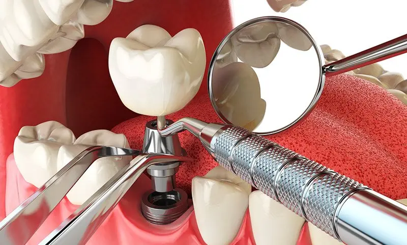 cuanto vale un implante de diente - Cuánto cuesta la corona de un implante