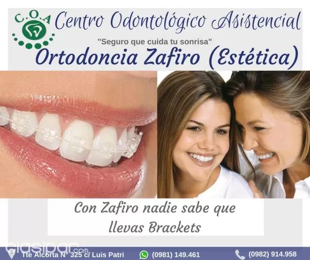 ortodoncia paraguay - Cuánto cuesta un tratamiento de ortodoncia en Paraguay