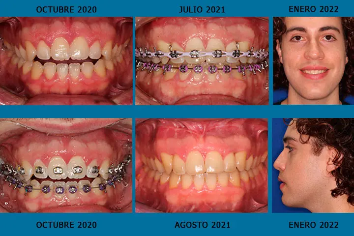 dentista maxilofacial - Cuánto cuesta una cirugía maxilofacial en Argentina