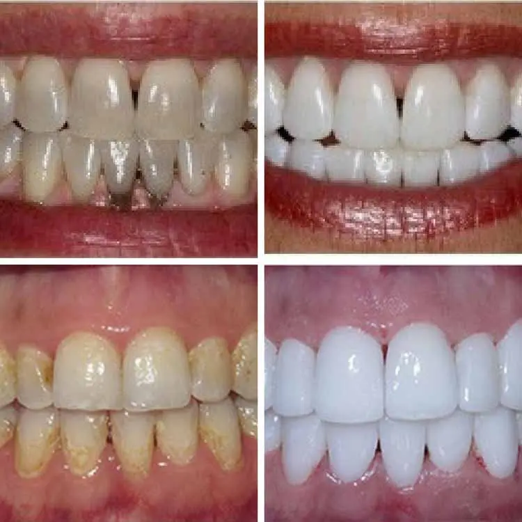 limpieza de dientes antes y despues - Cuánto dura limpieza dental antes y después