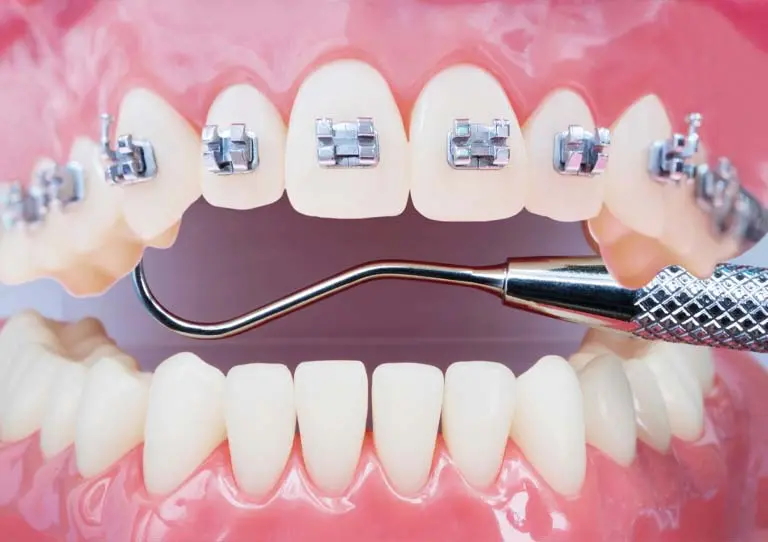 cuanto dura un tratamiento de ortodoncia - Cuánto es lo máximo que dura un tratamiento de ortodoncia