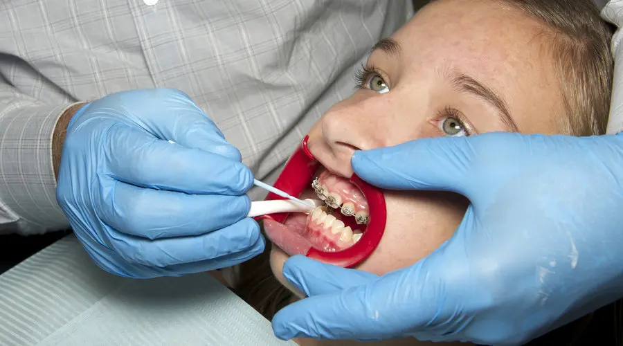 espaciador de dientes para niños - Cuánto tiempo se usan los separadores dentales