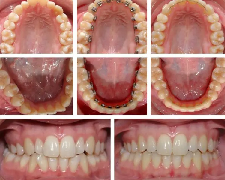 ortodoncia lingual precio - Cuánto vale la ortodoncia lingual