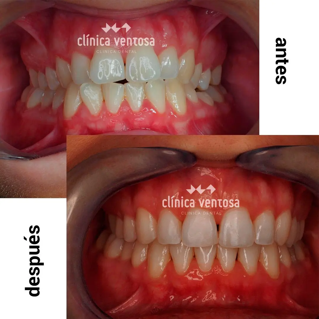 Ortodoncia Invisalign Precios En Argentina DENTALINE