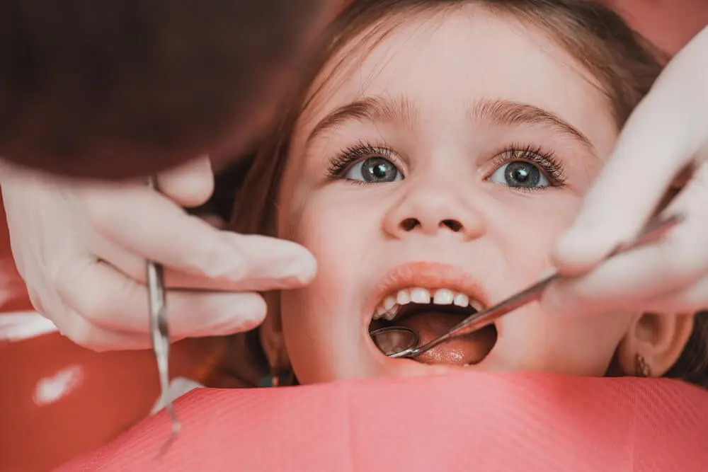 sellado de dientes - Qué dientes se pueden sellar