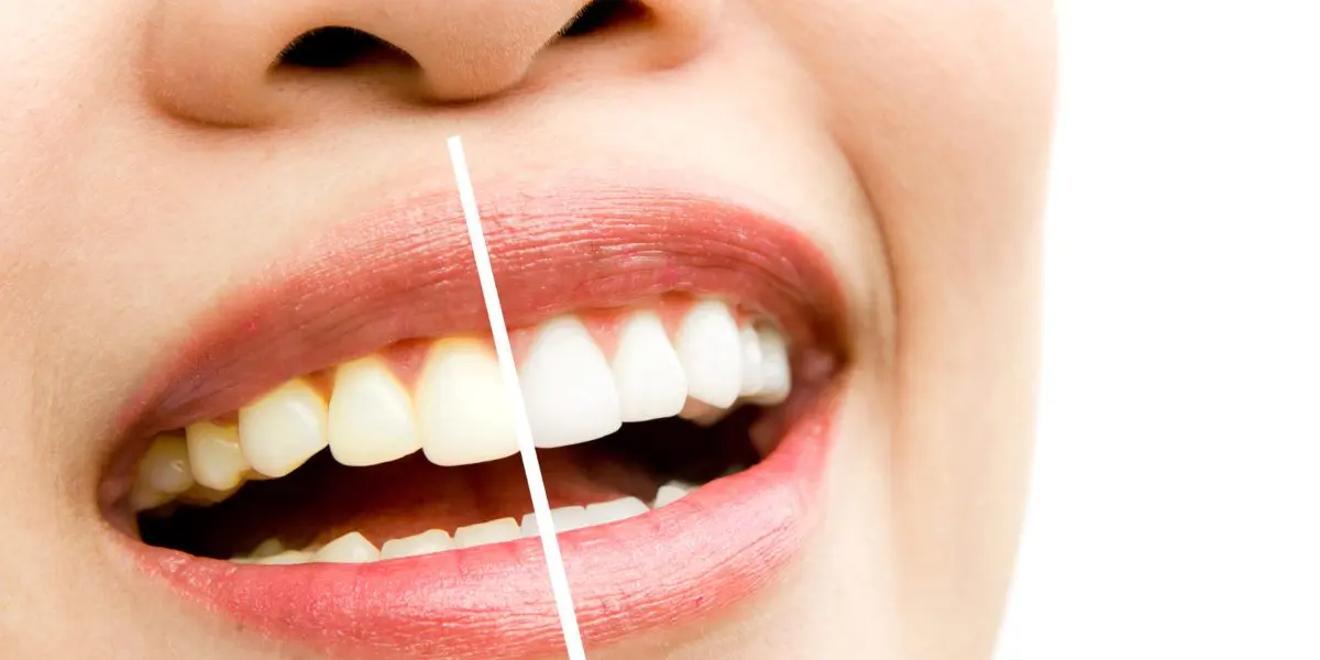 a que se debe los dientes amarillos - Qué enfermedad causa dientes amarillos