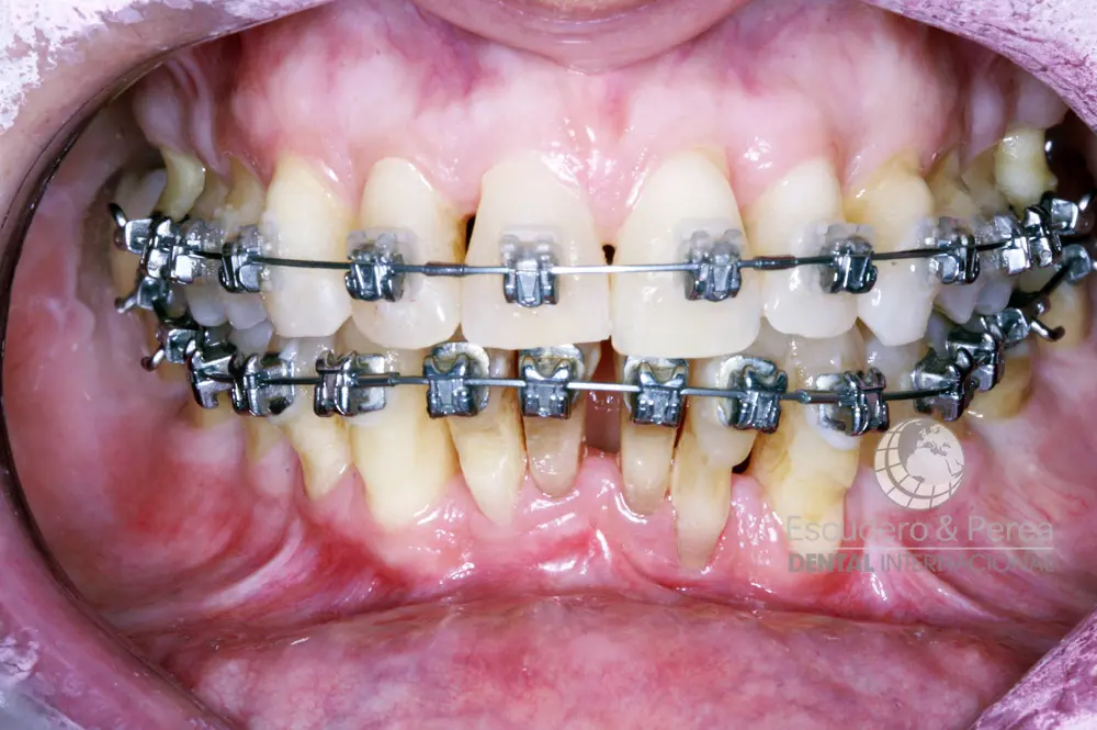 ortodoncia para pacientes con perdida de hueso - Qué es bueno para regenerar el hueso