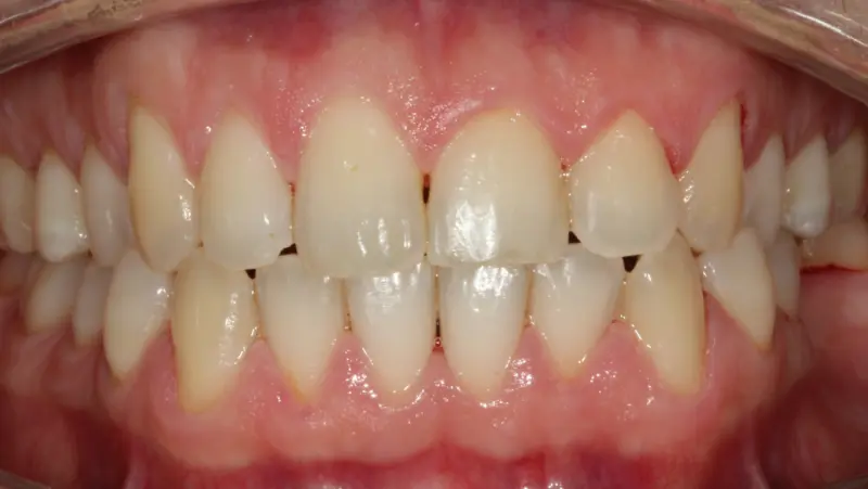 ultrasonido dentista - Qué es la limpieza bucal con ultrasonidos