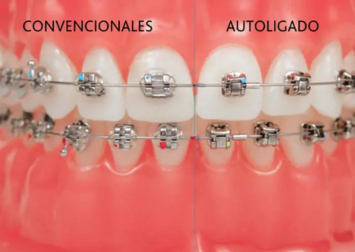 ortodoncia autoligado - Qué es mejor brackets de autoligado o convencional
