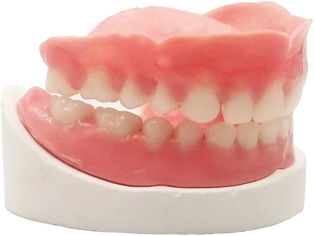 placa de dientes postizos - Qué es mejor implante o placa dental