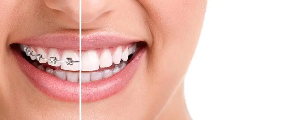 corrector de dientes - Qué es un corrector dental
