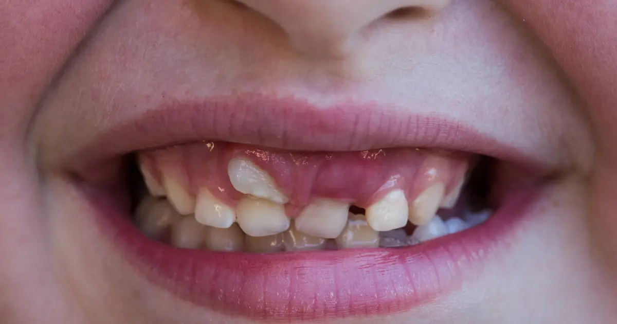 dientes parejos - Qué es un diente ectópico
