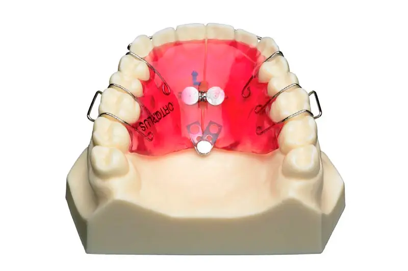 tornillo abanico ortodoncia - Qué es un tornillo de expansión