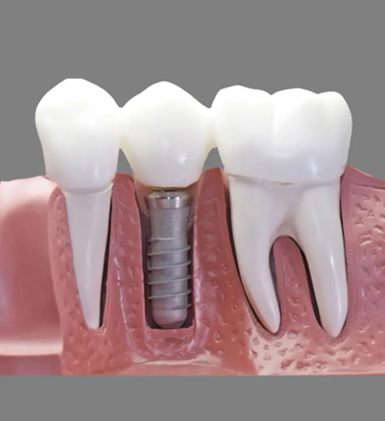 dientes postizos de emergencia - Qué es una prótesis dental inmediata