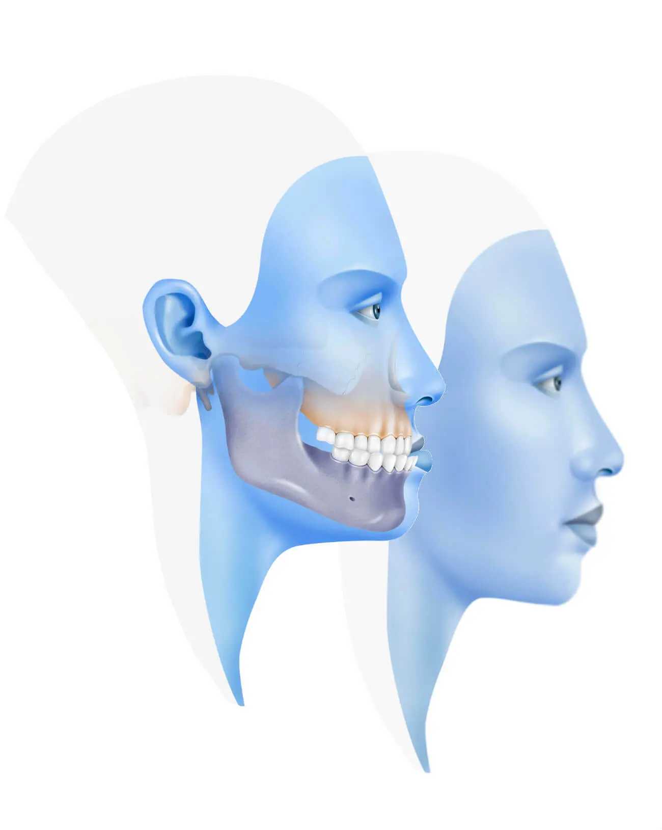 ortodoncia clase 3 - Qué hacer con una mordida clase 3