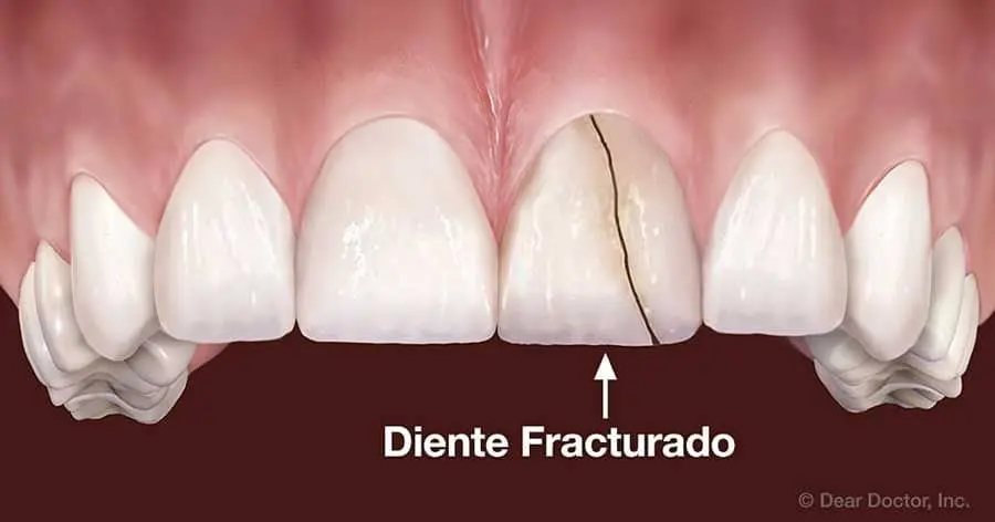 diente fracturado raiz - Qué hacer en caso de fractura radicular