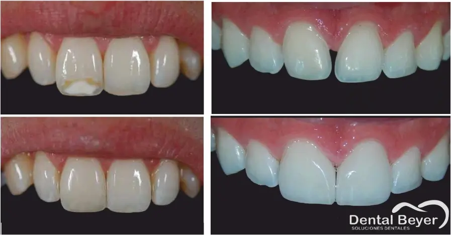 emparejamiento de dientes - Qué se hace para emparejar los dientes