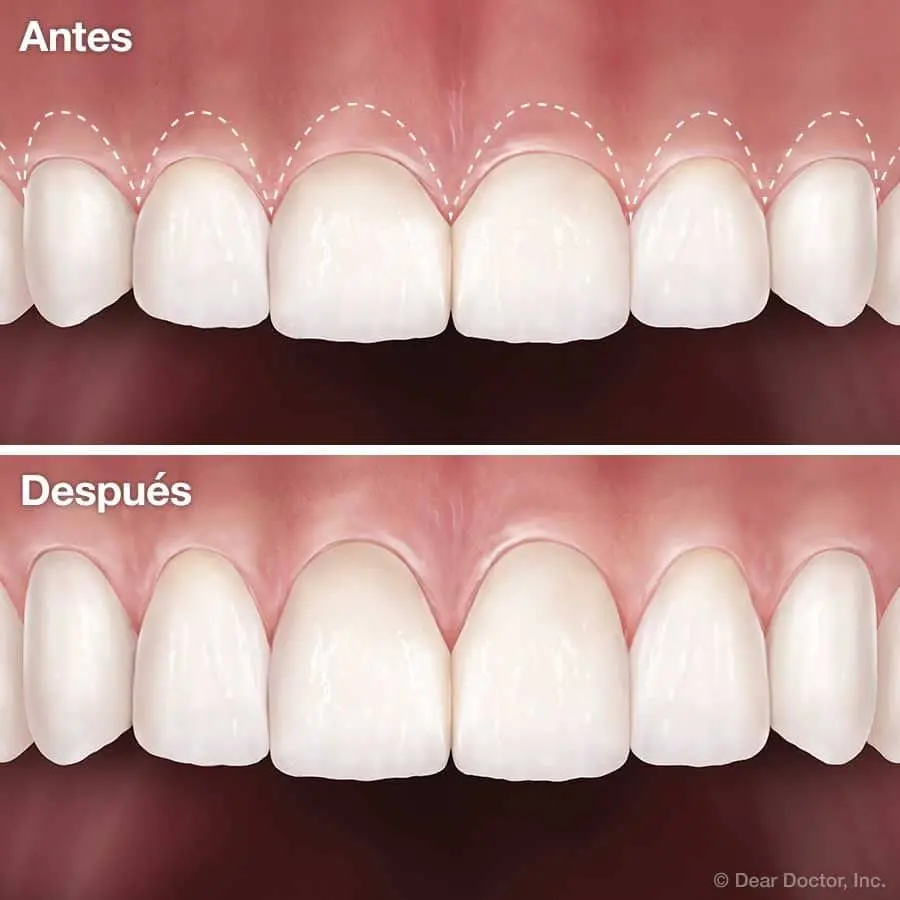 operacion dientes - Qué significa cirugía dental